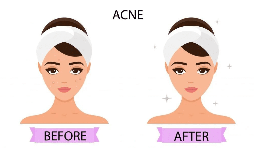animated before and after acne treatment