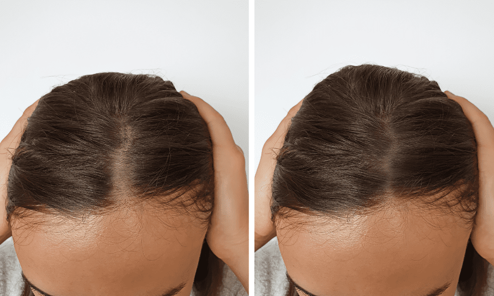 Hair Plugs vs Hair Implants
