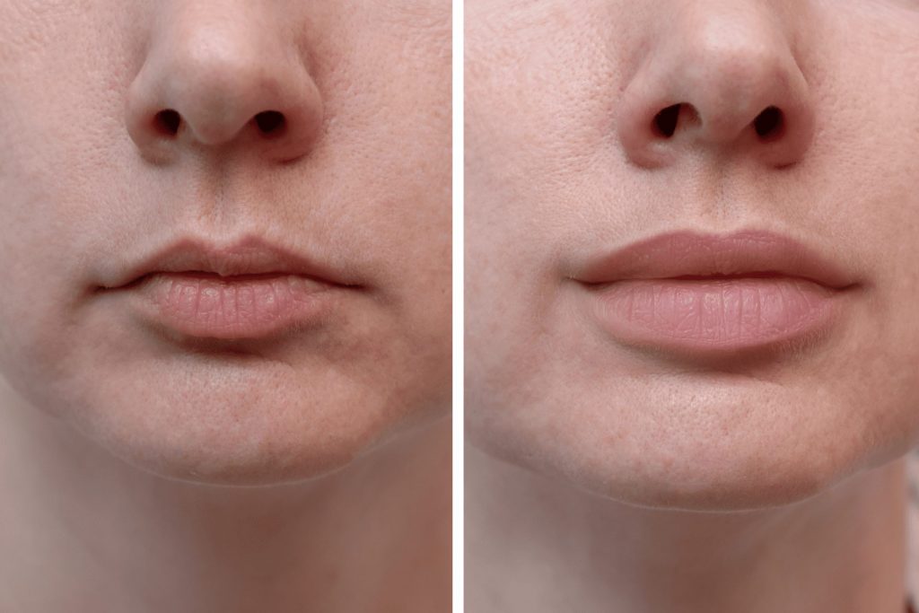 Stages Healing Lip Filler Swelling Timeline